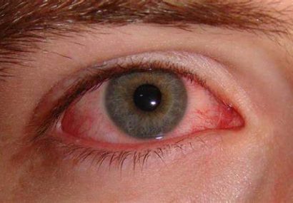 التهاب چشم /از نشانه‌های تهاجم کرونا